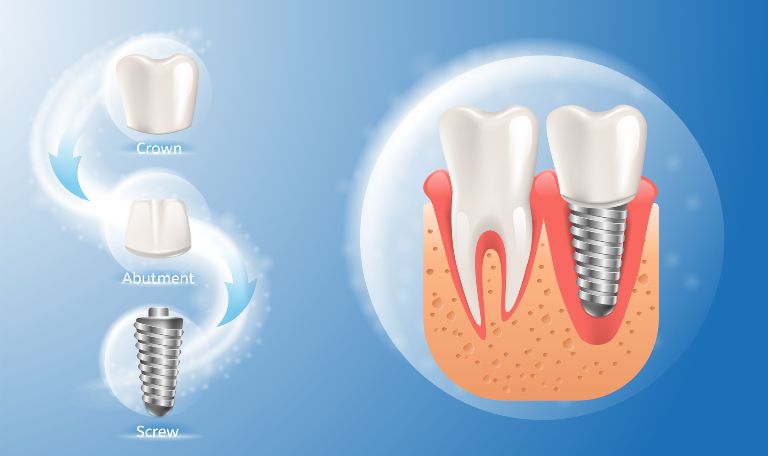 этапы процедуры имплантации зубов