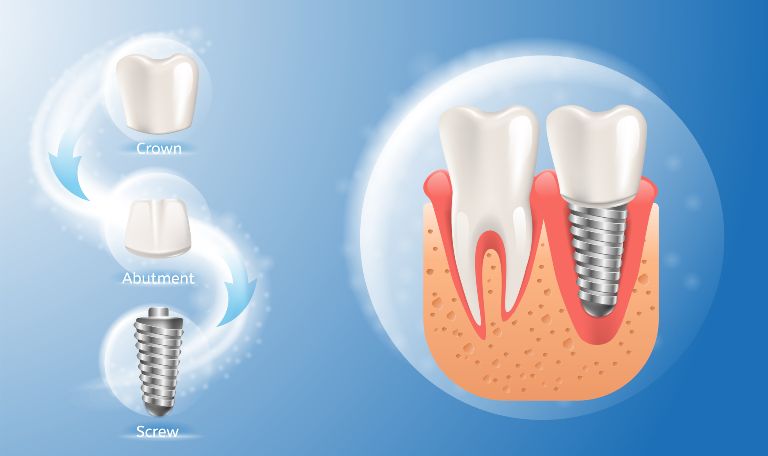 dental implant procedure steps