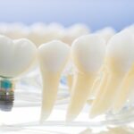 dental implant procedure steps