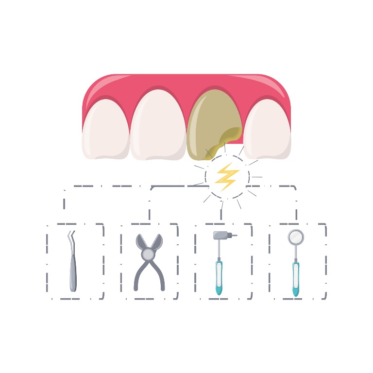 chipped teeth-dentist near me