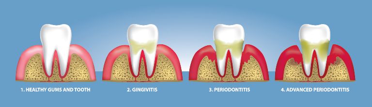 gum recesion