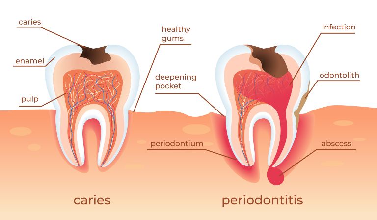 gum recession