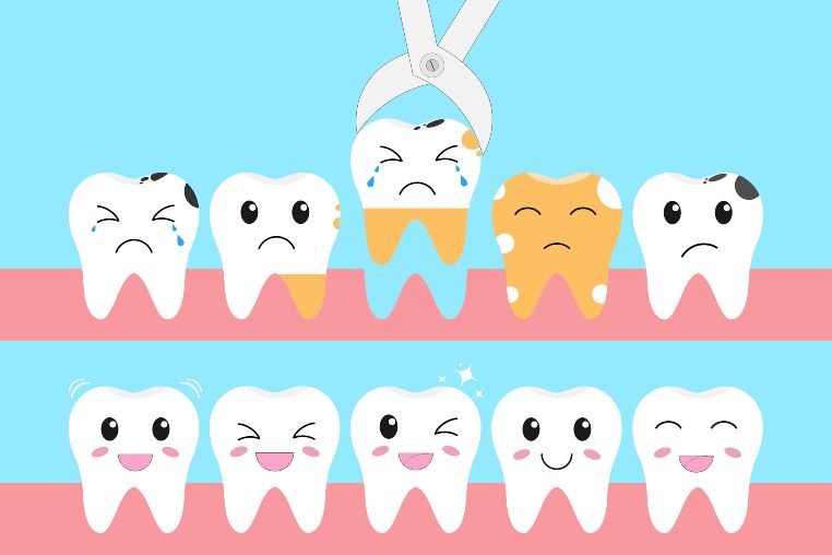 how to prevent tooth decay in toddlers