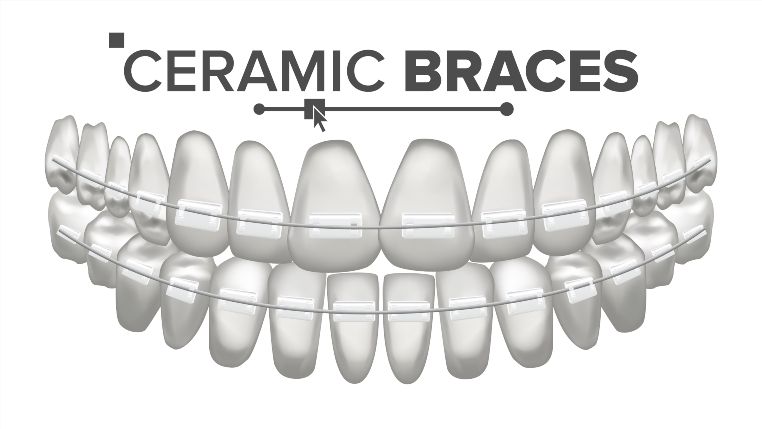 What Are Ceramic Braces?, Pros & Cons of Ceramic Braces