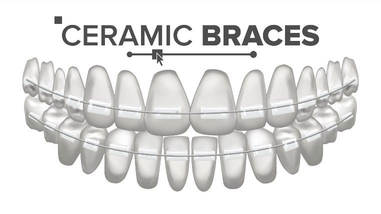 ceramic braces