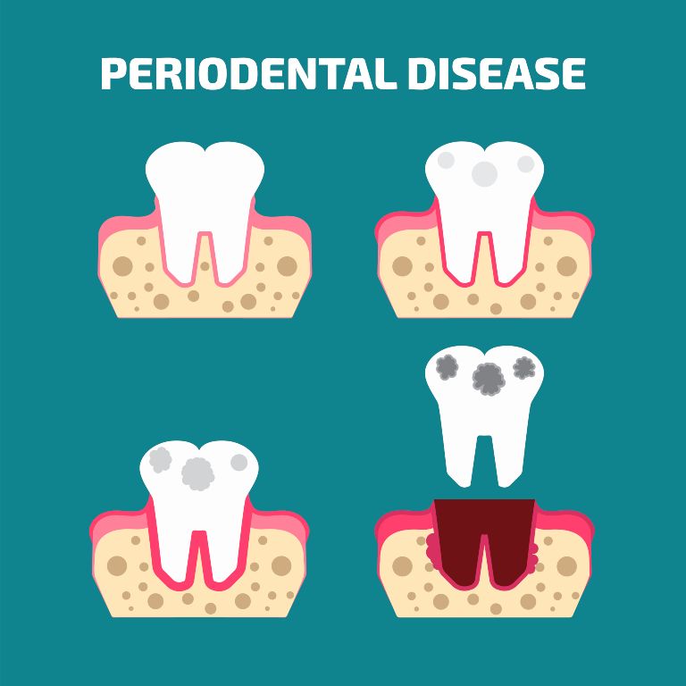 gum disease