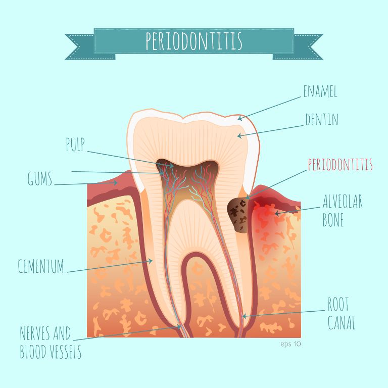 periodontitis disease