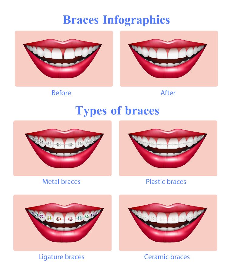 types of braces