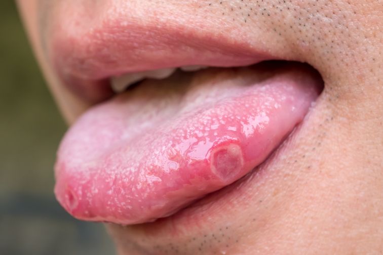 canker sores on tongue