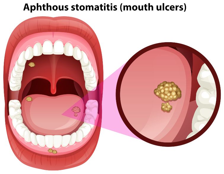 How To Get Rid Of Canker Sores And What Can Happen If You Don't