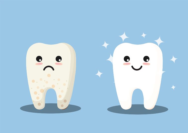 fluorosis on teeth