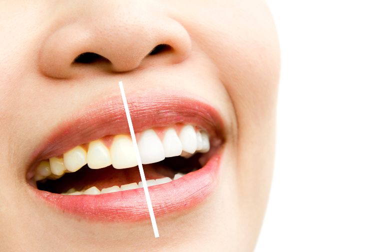 A woman's teeth before and after teeth whitening.