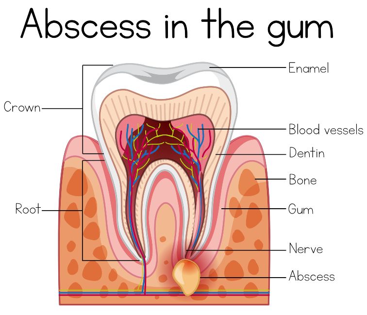 dental cyst vs abscess