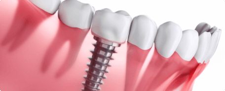 An image of a dental implant in a patient's mouth.