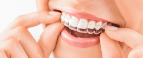 A woman is putting her teeth into a clear aligner.