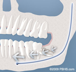 A diagram showing the placement of a dental implant.