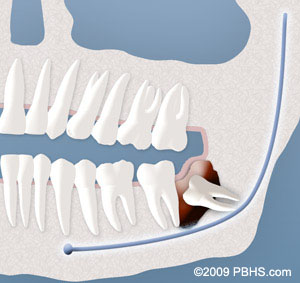 An illustration of a tooth with a broken tooth.