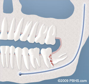 A diagram of a tooth with a broken tooth.