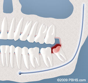 An illustration of a tooth with a broken tooth.