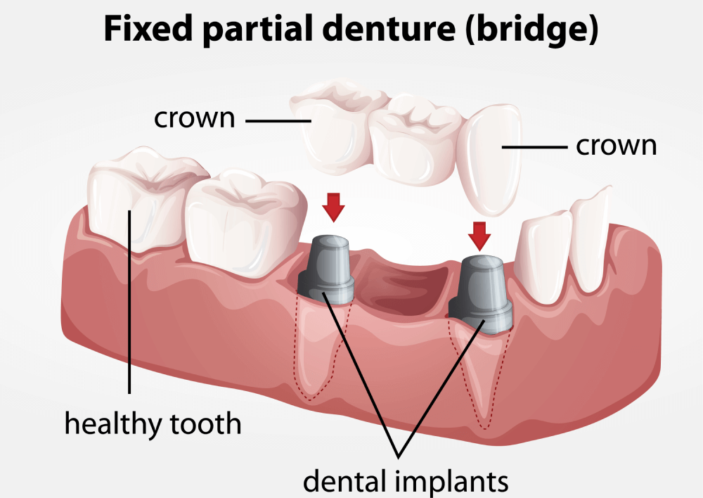 Fixed partial denture bridge.