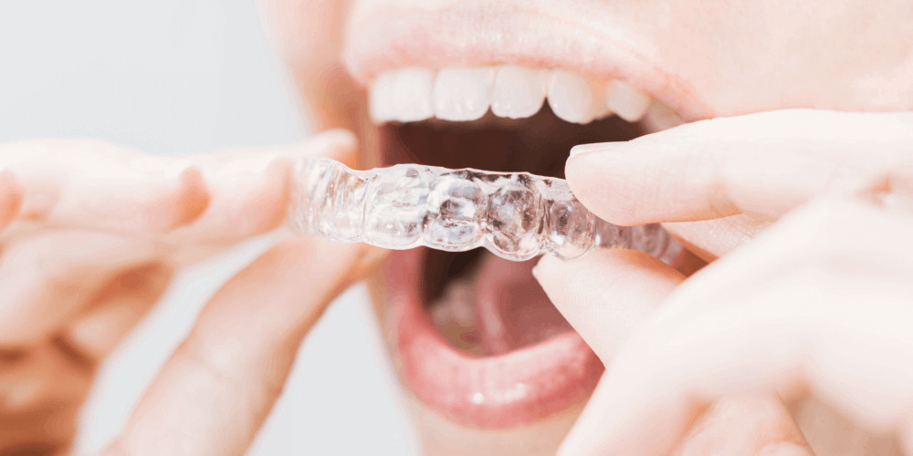 A woman is holding a clear aligner in her mouth.