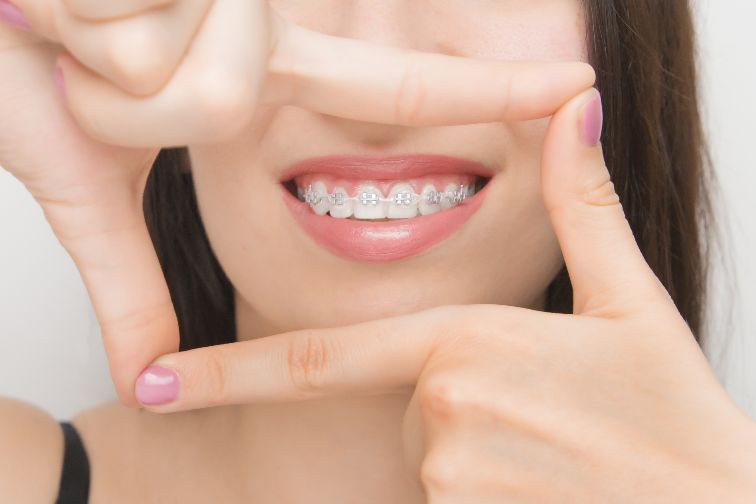 self ligating braces meaning