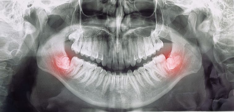 molar teeth gum pain