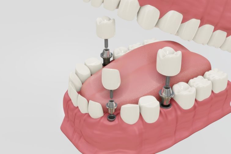 how do mini dental implants work