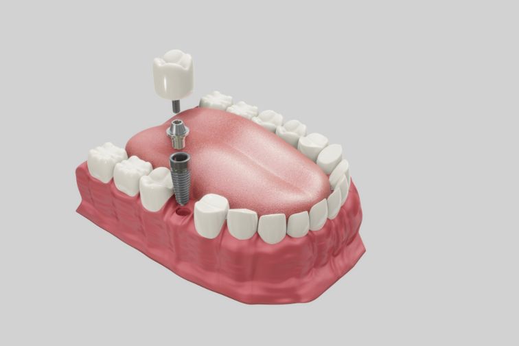 bone graft dental