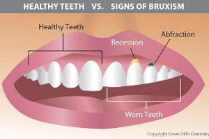 Signs of bruxism.