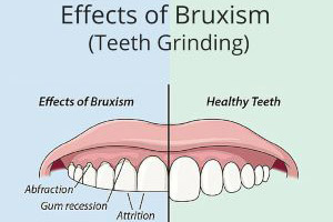 The effects of bruxism on teeth.