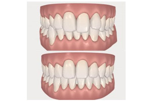 A pair of teeth that have been whitened.