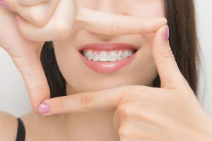 A young woman showing her teeth with braces.
