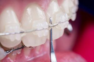 Close up of a person's teeth with braces.