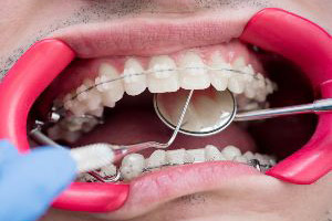 A man is getting braces on his teeth.