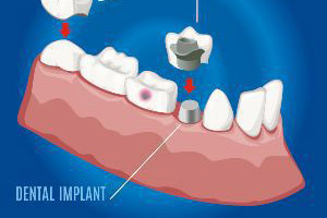 An illustration of a dental implant in a patient's mouth.