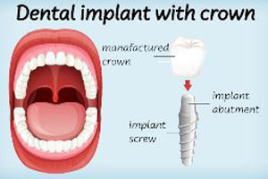 Dental implant with crown.