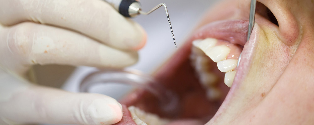 A child's mouth being examined by a dental hygienist.