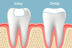 A tooth with an inlay and an olay.