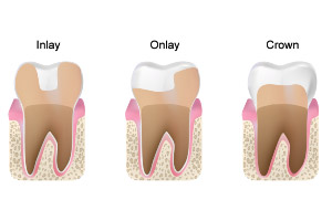 A diagram showing the stages of tooth decay.