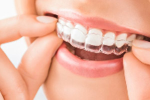 A woman with clear braces on her teeth.