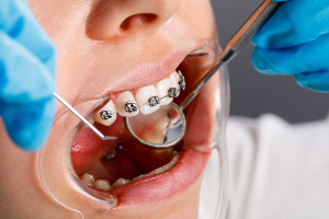 A woman is getting braces on her teeth.