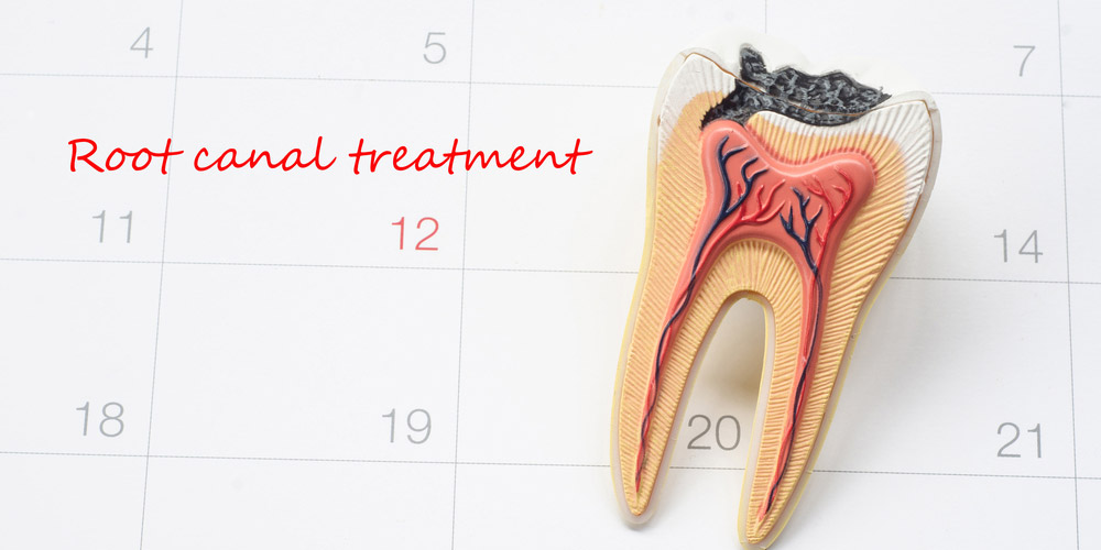 A model of a tooth on a calendar with the words root canal treatment.