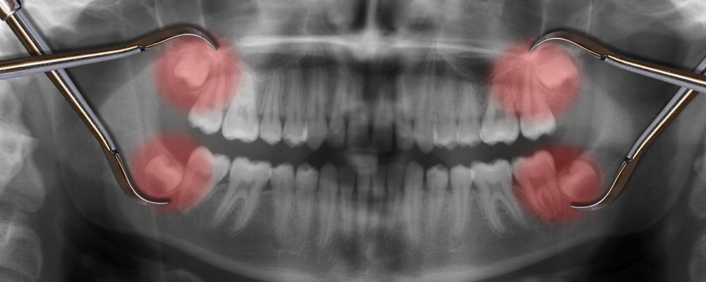 A x - ray of a tooth with a pair of pliers.