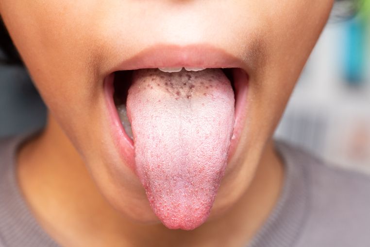 tongue discoloration