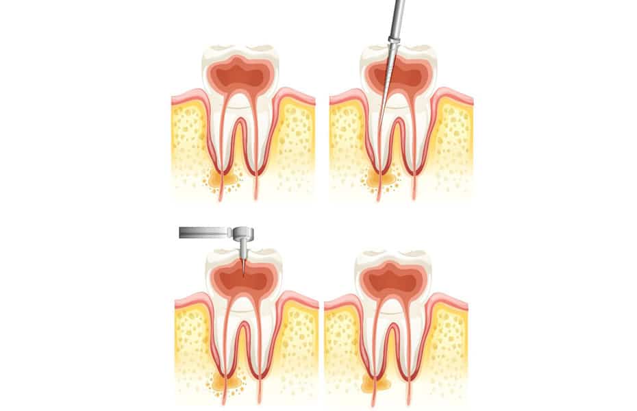 A diagram of a tooth.