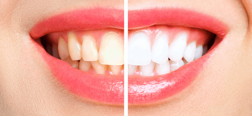 A woman's teeth before and after teeth whitening.