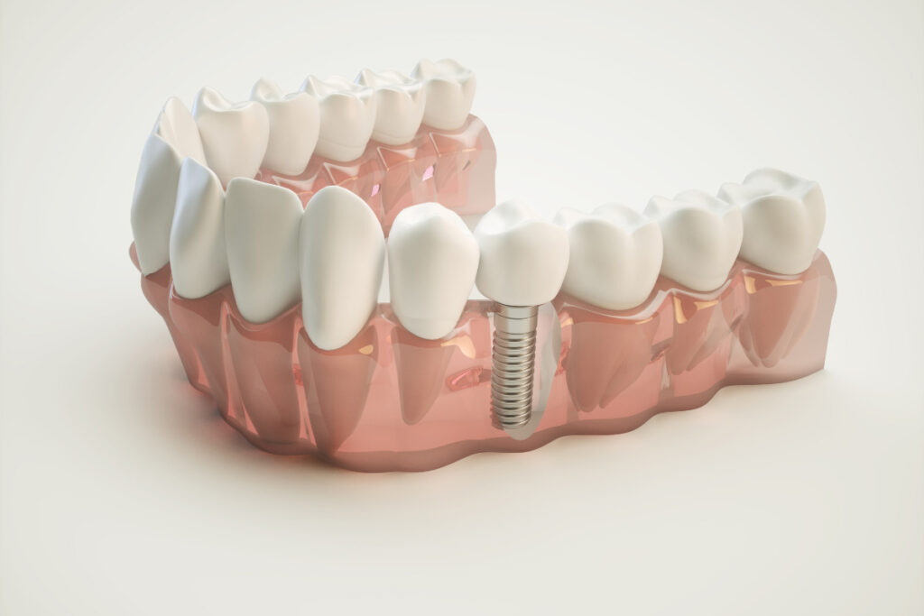 A model of a dental implant on a white background showcasing the intricate details.